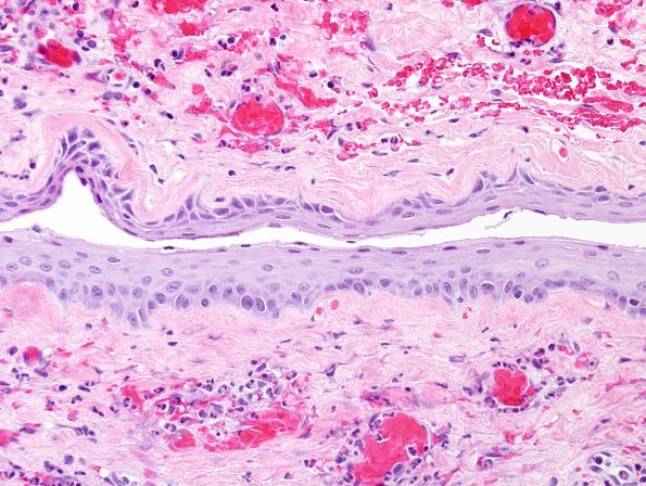 8B2 Cyst, neurenteric & Squamous metaplasia (Case 8) H&E 3