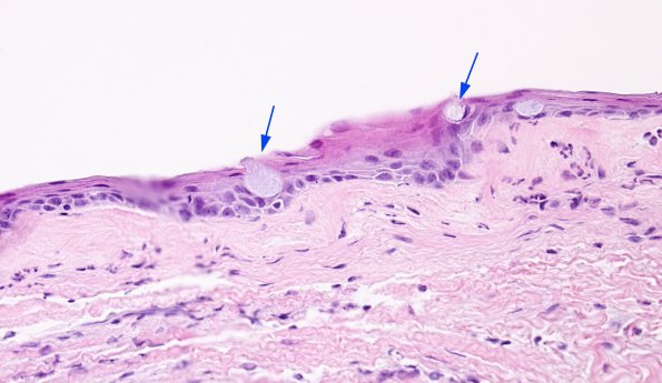 8B3 Cyst, neurenteric & Squamous metaplasia (Case 8) H&E 5