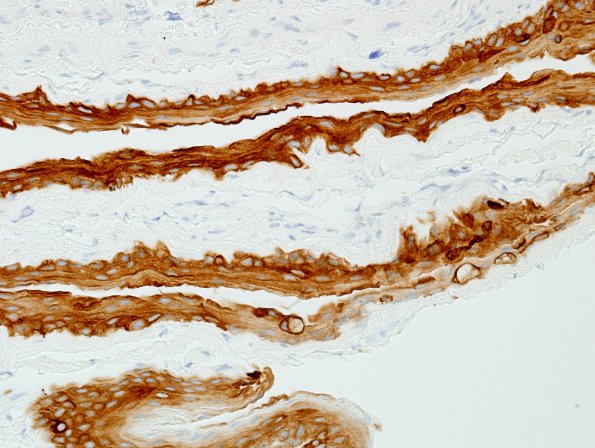 8C1 Cyst, neurenteric (Case 8) Pan Keratin 1