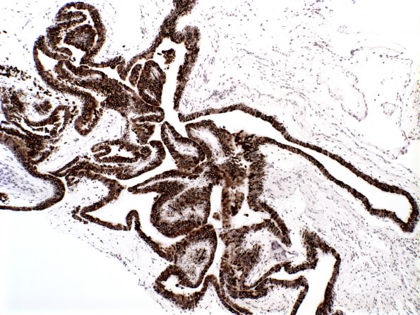 9A1 Cyst, Neurenteric (Case 9) cytokeratin