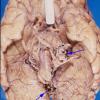 Cyst - Epidermoid