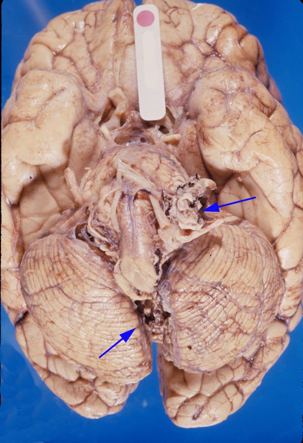 1A1 Cyst, Epidermoid (Case 1) 3