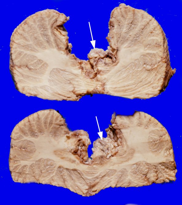 1A2 Cyst, Epidermoid (Case 1) 2A