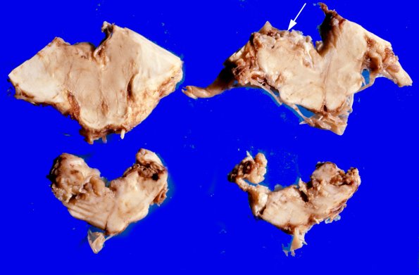 1A3 Cyst, Epidermoid (Case 1) 1A