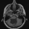 3A1 Cyst, epidermoid (Case 3) T1