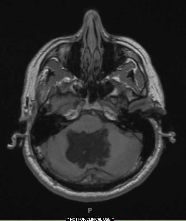 3A1 Cyst, epidermoid (Case 3) T1