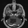 3A2 Cyst, epidermoid (Case 3) T1 W