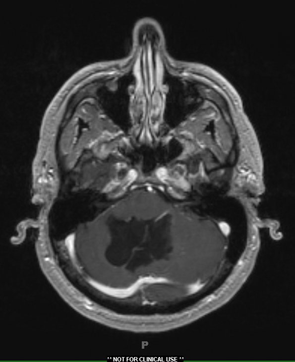 3A2 Cyst, epidermoid (Case 3) T1 W