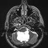 3A3 Cyst, epidermoid (Case 3) T2