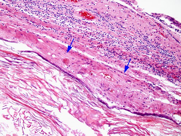 3B4 Cyst, epidermoid (Case 3) H&E 1