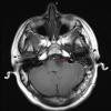 4A1 Cyst, epidermoid (Case 4) T1