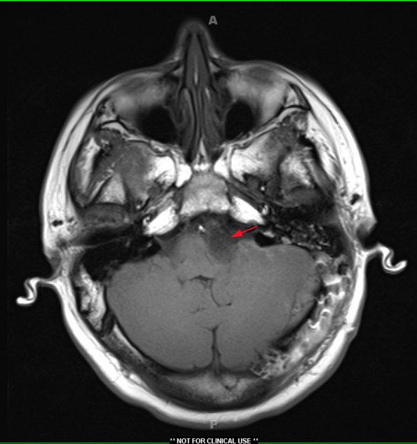 4A1 Cyst, epidermoid (Case 4) T1