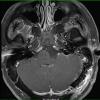 4A2 Cyst, epidermoid (Case 4) T1 W