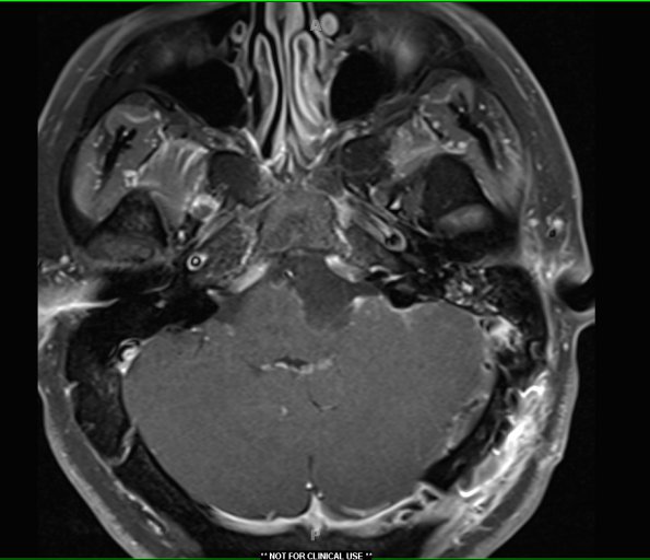 4A2 Cyst, epidermoid (Case 4) T1 W