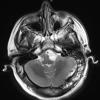 4A3 Cyst, epidermoid (Case 4) T2 W