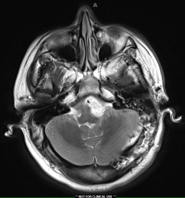 4A3 Cyst, epidermoid (Case 4) T2 W