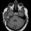 5A1 Cyst, epidermoid (Case 5) T1