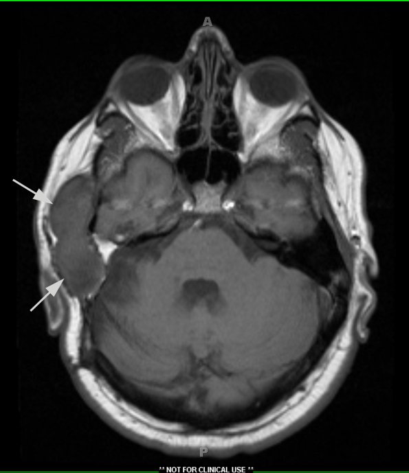 5A1 Cyst, epidermoid (Case 5) T1