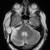 5A2 Cyst, epidermoid (Case 5) T2