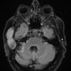 5A3 Cyst, epidermoid (Case 5) FLAIR