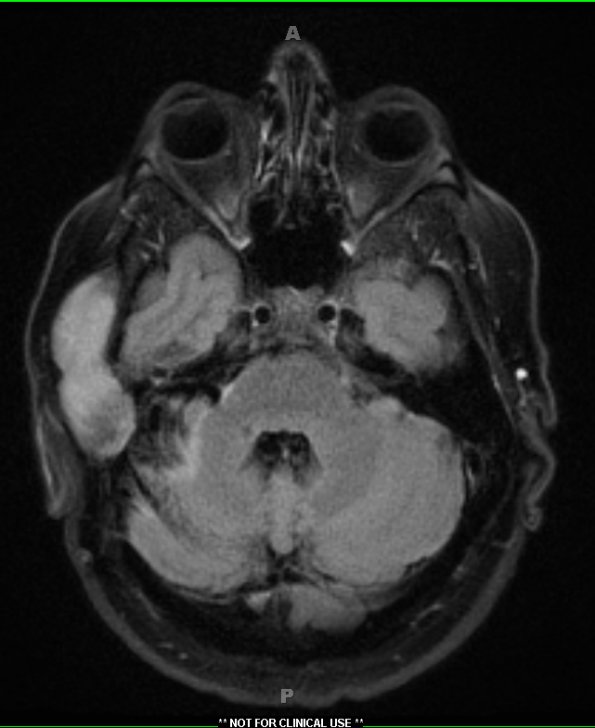 5A3 Cyst, epidermoid (Case 5) FLAIR