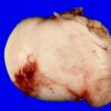 5B1 Cyst, epidermoid (Case 5) 1A