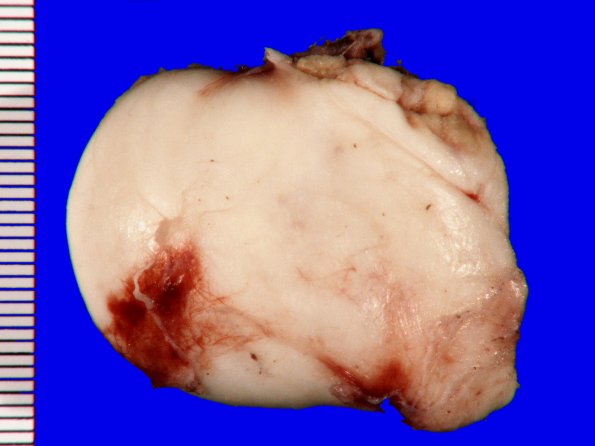 5B1 Cyst, epidermoid (Case 5) 1A