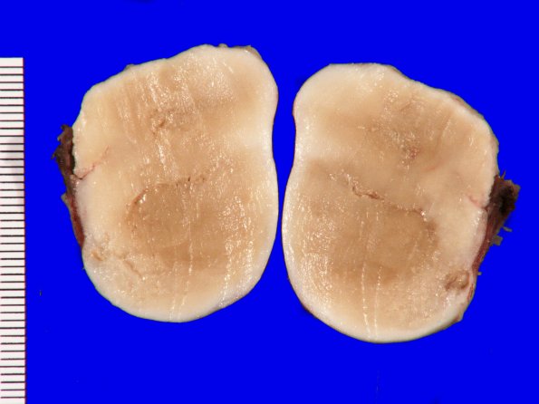 5B2 Cyst, epidermoid (Case 5) 2 A