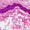 5C2 Cyst, epidermoid (Case 5) H&E 5