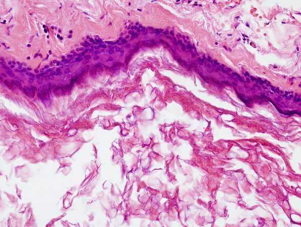 5C2 Cyst, epidermoid (Case 5) H&E 5