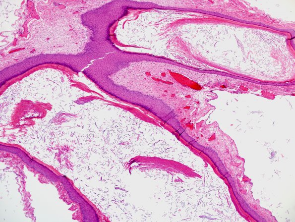 6A1 Cyst, epidermoid & sinus tract (Case 6) H&E 7