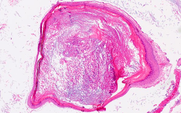 6A4 Cyst, epidermoid & sinus tract (Case 6) H&E 1A