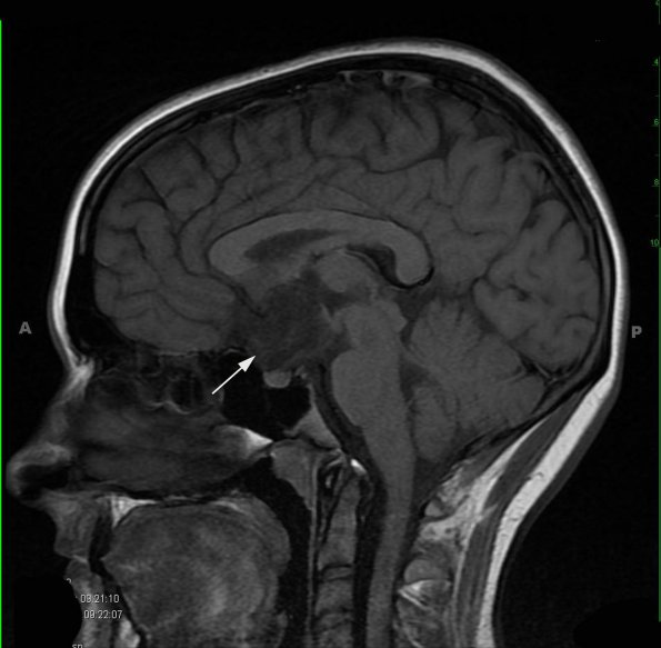 7A1 Cyst, epidermoid (Case 7) T1