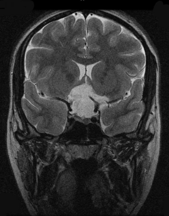 7A2 Cyst, epidermoid (Case 7) T2 3