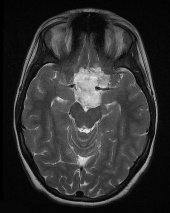 7A3 Cyst, epidermoid (Case 7) T2 5