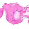 8A1 Cyst, Epidermoid (Case 8) H&E whole moun