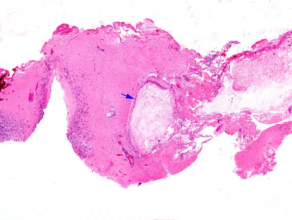 8A1 Cyst, Epidermoid (Case 8) H&E whole moun