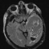 9A1 Cyst, epidermoid (Case 9) T2 FLAIR