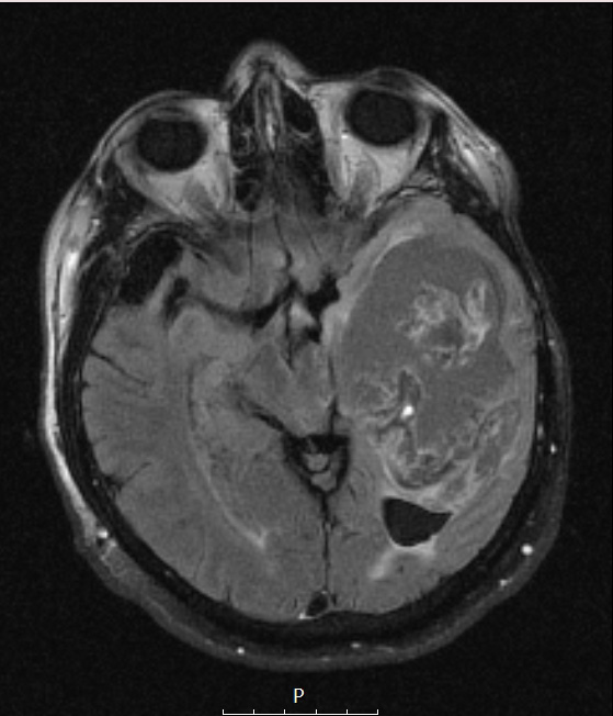 9A1 Cyst, epidermoid (Case 9) T2 FLAIR