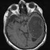 9A2 Cyst, epidermoid (Case 9) T1