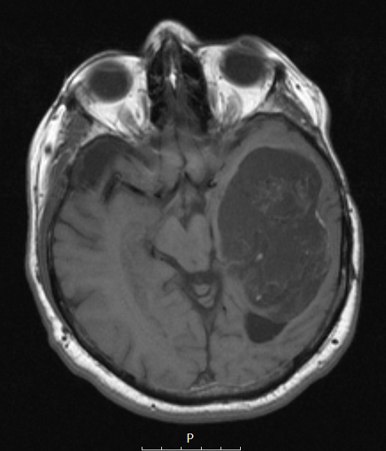 9A2 Cyst, epidermoid (Case 9) T1