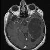 9A3 Cyst, epidermoid (Case 9) T1W