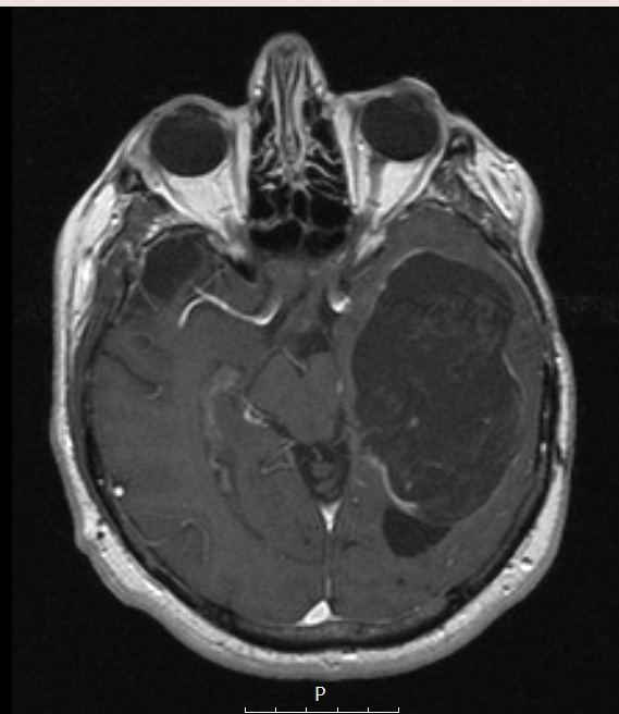 9A3 Cyst, epidermoid (Case 9) T1W