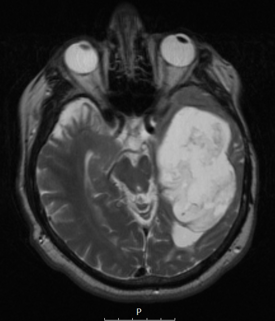 9A4 Cyst, epidermoid (Case 9) T2W