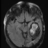 9B1 Cyst, epidermoid (Case 9)) T2 FLAIR