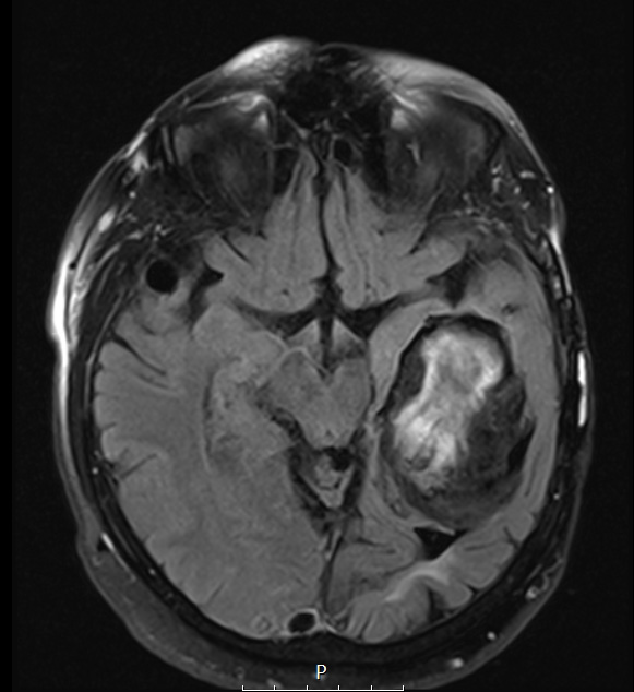 9B1 Cyst, epidermoid (Case 9)) T2 FLAIR