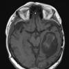 9B2 Cyst, epidermoid (Case 9)) T1NoC