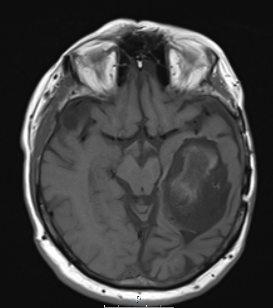 9B2 Cyst, epidermoid (Case 9)) T1NoC