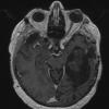 9B3 Cyst, epidermoid (Case 9) T1W