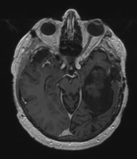 9B3 Cyst, epidermoid (Case 9) T1W